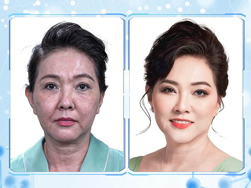 Diễn viên Phương Dung thực hiện trẻ hóa da tại Viện thẩm mỹ KangJin 