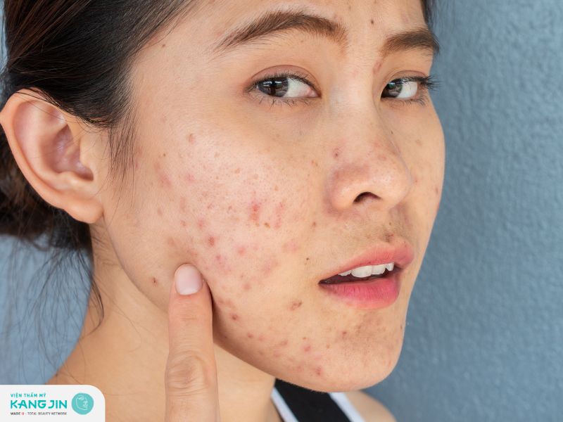 Các dạng viêm da mặt thường gặp 