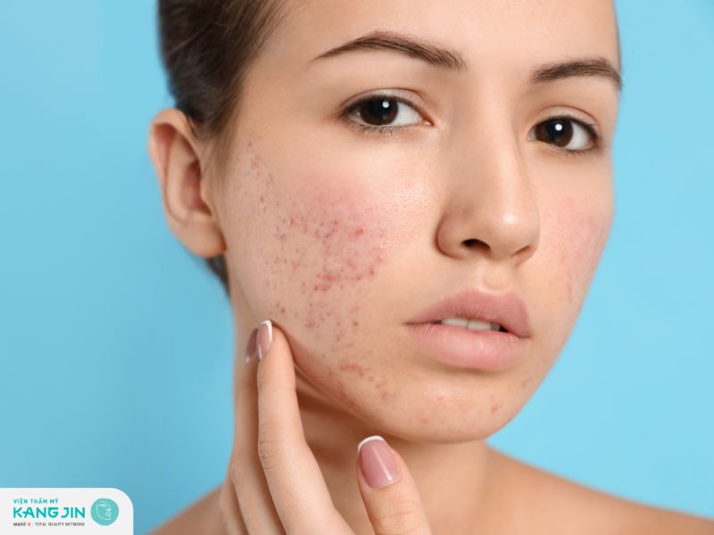 Các bước chăm sóc da mụn tuổi dậy thì an toàn và hiệu quả 