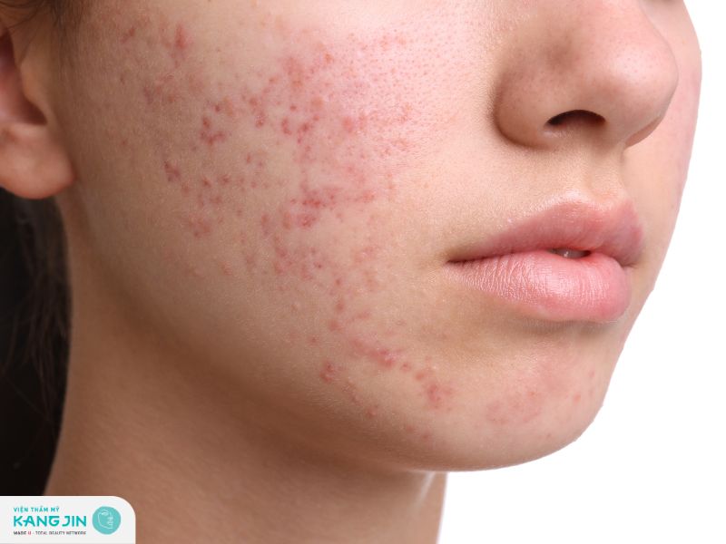 da mặt nhiễm corticoid