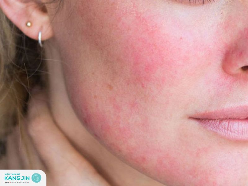 Dấu hiệu nhận biết bệnh viêm da dị ứng trên mặt 