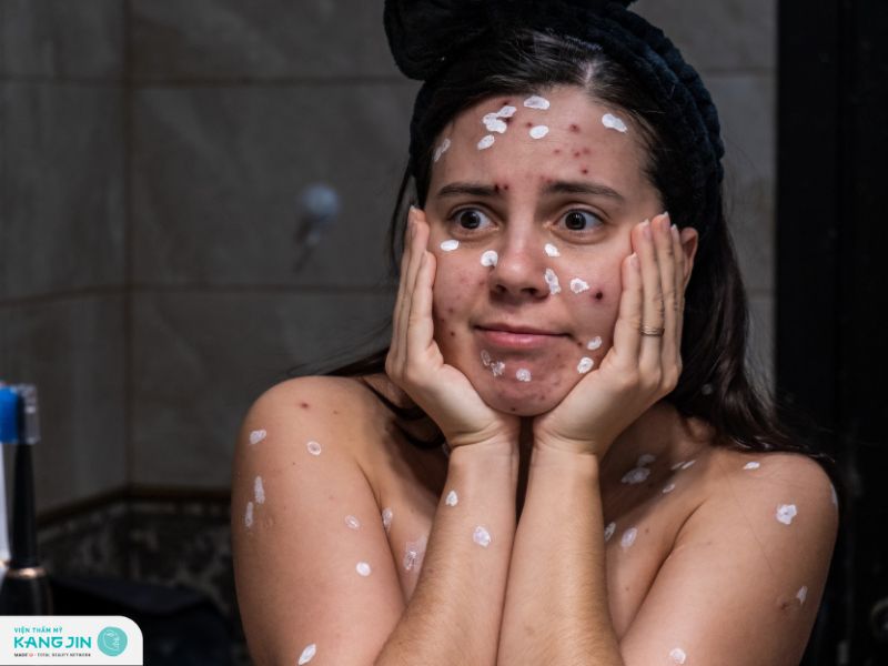 phục hồi da mặt bị rỗ