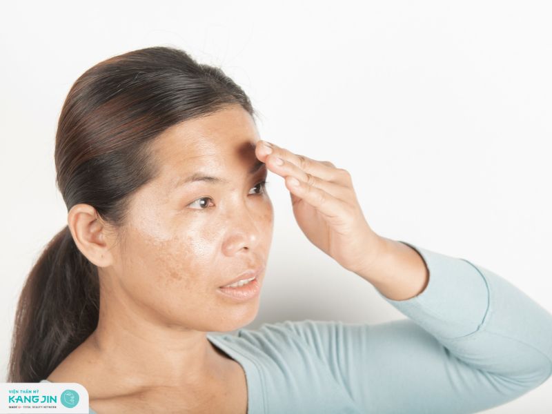 trị nám bằng mẹo dân gian