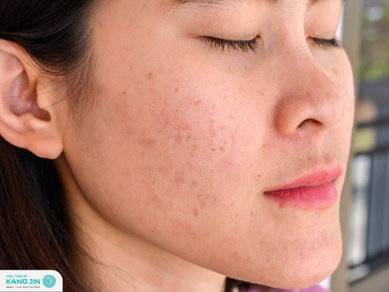 trị nám tàn nhang