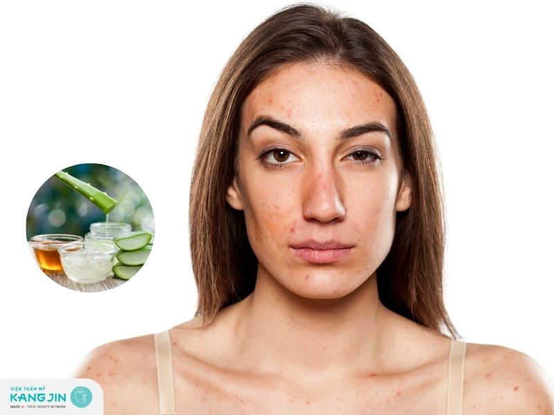 Tổng hợp các cách giảm kích ứng da mặt bằng nguyên liệu thiên nhiên 