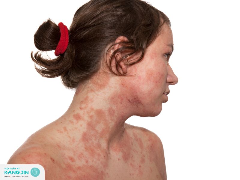 Tìm hiểu nguyên nhân bị chàm da mặt gây mẩn đỏ bong vẩy 