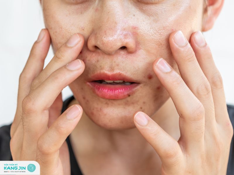 da mặt bị nhờn