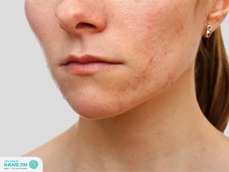 Dấu hiệu để nhận biết bị chàm da mặt 