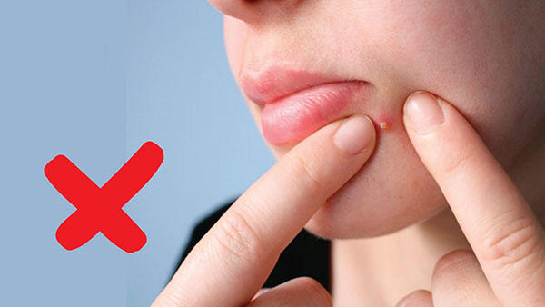 Hạn chế nặn mụn hết sức có thể
