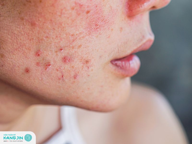 Xác định nguyên nhân gây mụn là cách điều trị mụn hiệu quả