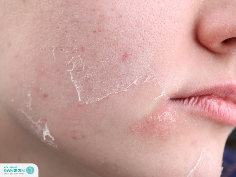 quá trình thay da nhân sâm