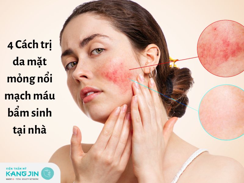 Da mặt mỏng nổi mạch máu bẩm sinh