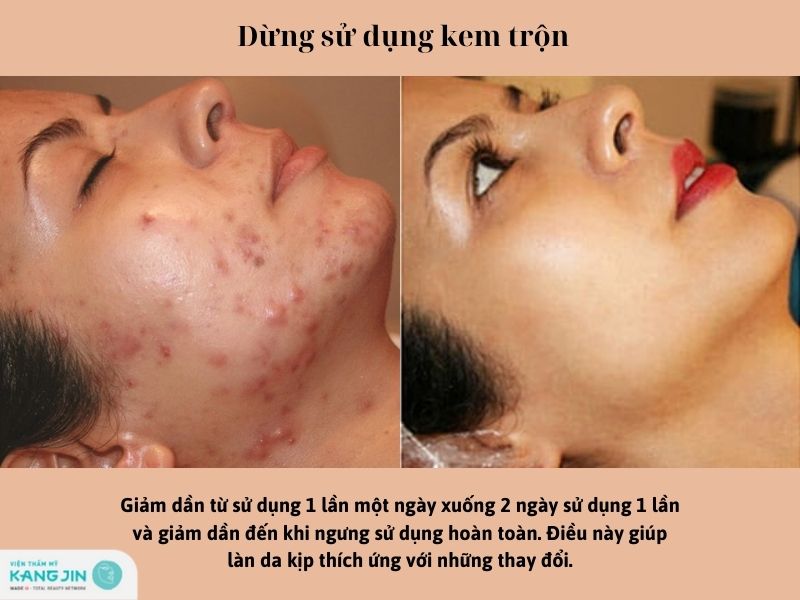 dừng hoặc giảm tần suất sử dụng kem trộn xuống