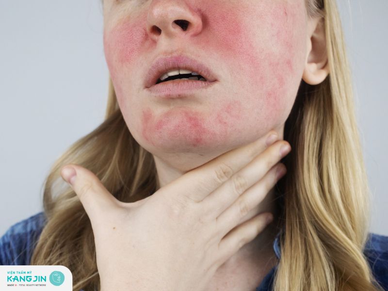 Cách phục hồi da giãn mao mạch an toàn và hiệu quả 