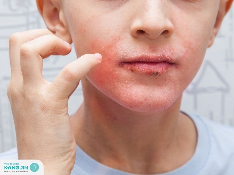 Da mặt dị ứng sần sùi: Nguyên nhân và cách khắc phục