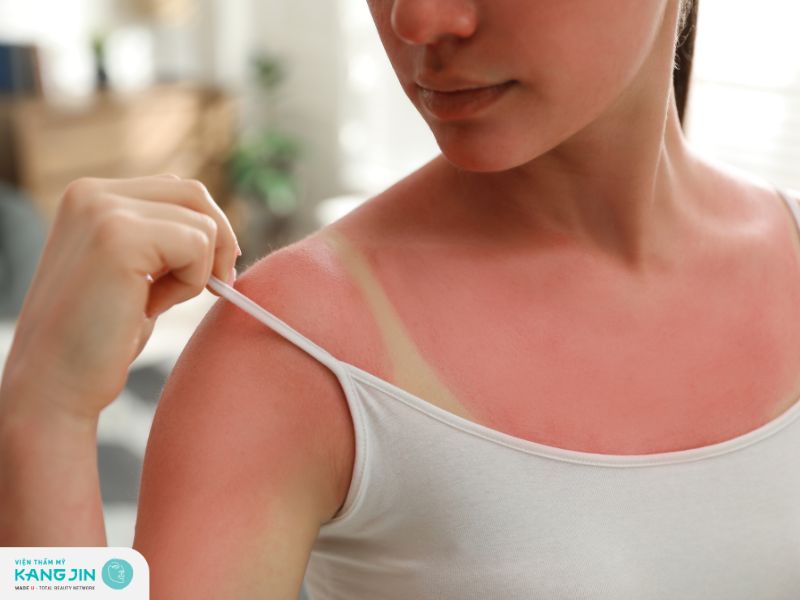 Da bị cháy nắng có trắng lại được không?