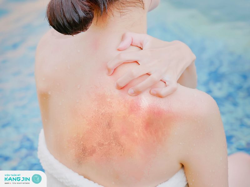 Da đau rát và đỏ nhiều hơn khi cháy nắng mức độ trung bình