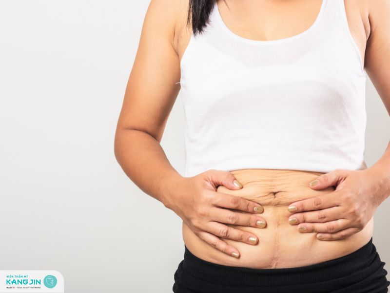 da bụng chùng nhão sau sinh