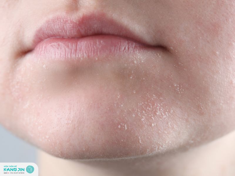 da mặt sần sùi khô ráp