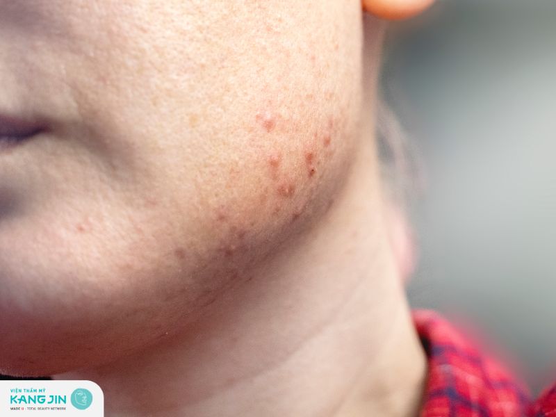 Thay đổi hormone gây mụn ở viền hàm