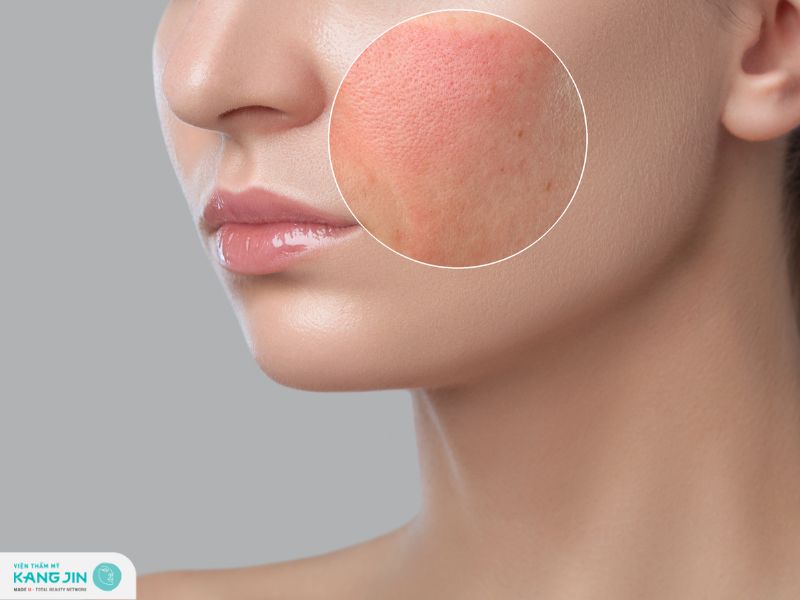 sưng mặt vì thuốc bắc tái tạo da