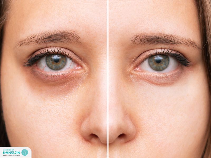 cách hết quầng thâm mắt trong 1 đêm