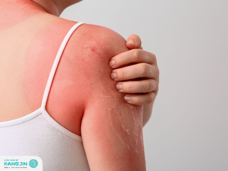  có phục hồi làn da bị cháy nắng được không?