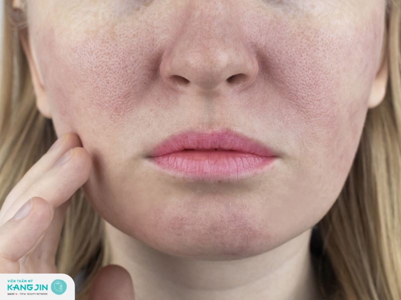 Tìm hiểu nguyên nhân khiến da lão hóa lỗ chân lông to