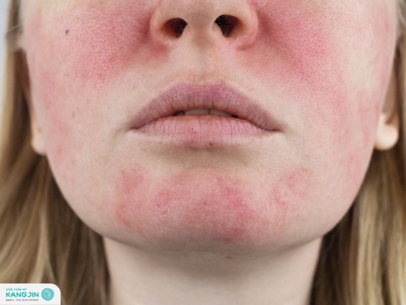 da mặt bị nhiễm corticoid phải làm sao