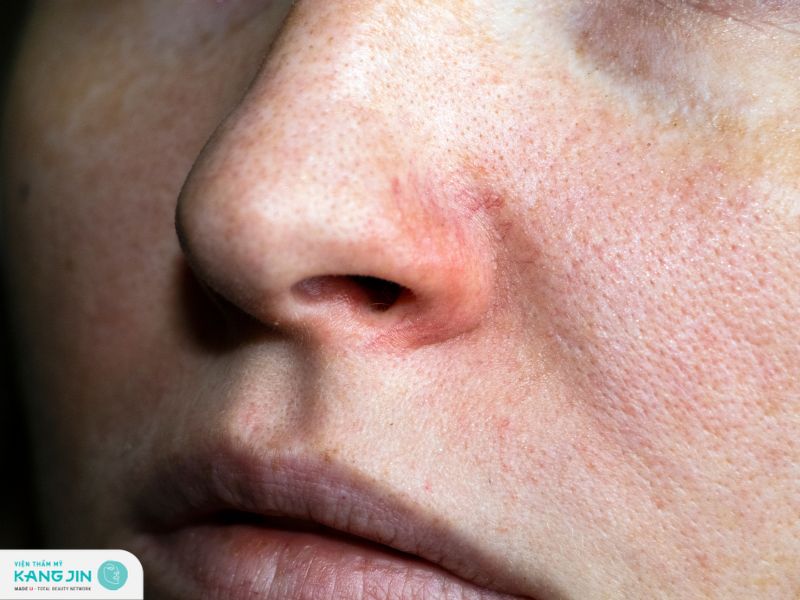 Làm gì để cải thiện lỗ chân lông to ở mặt