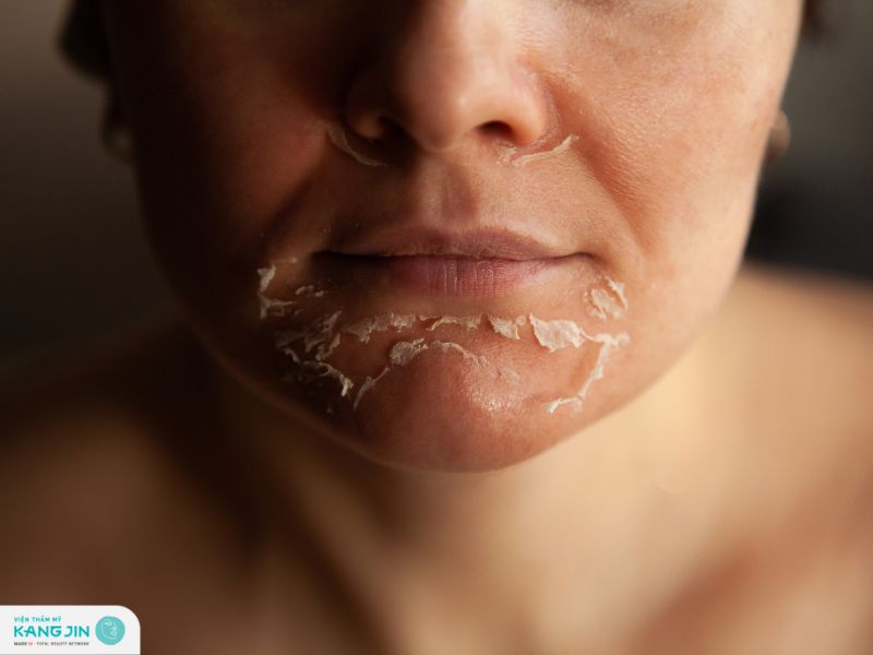 lột da mặt nhiều có tốt không