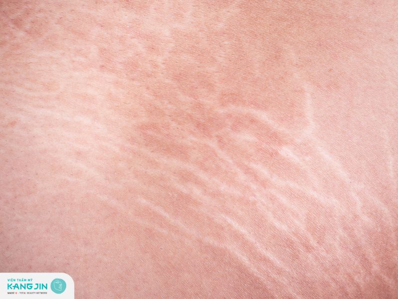 Những vết rạn da mặt gây mất thẩm mỹ