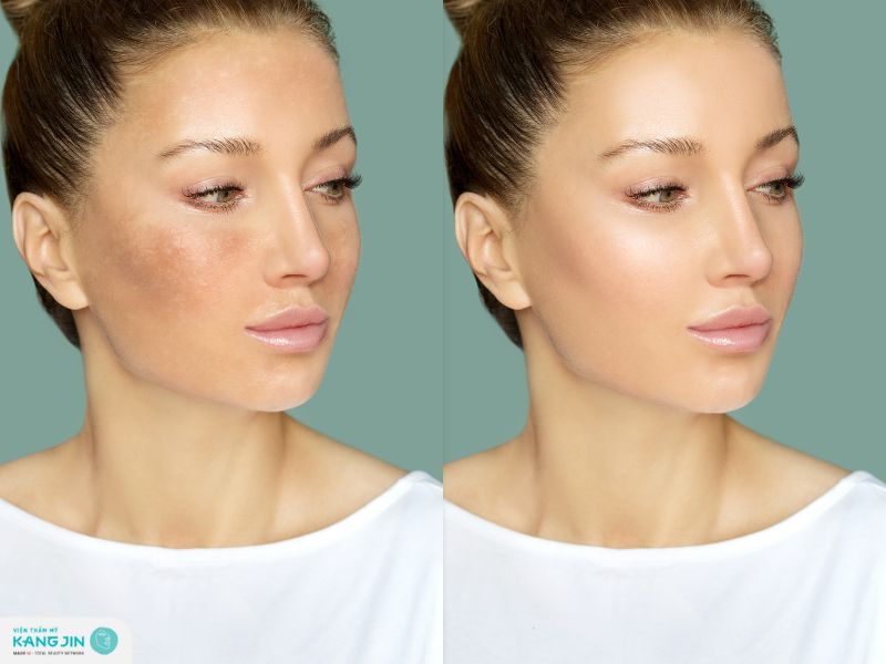 thời gian phục hồi da hư