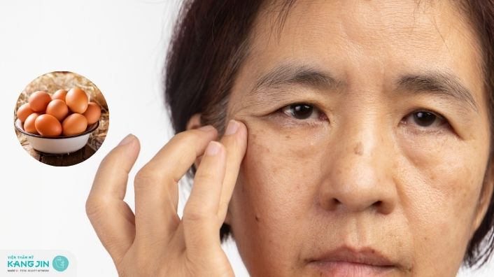 Cách xóa nếp nhăn vùng mắt từ trắng gà