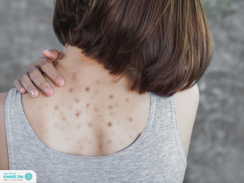 da lưng bị sạm đen