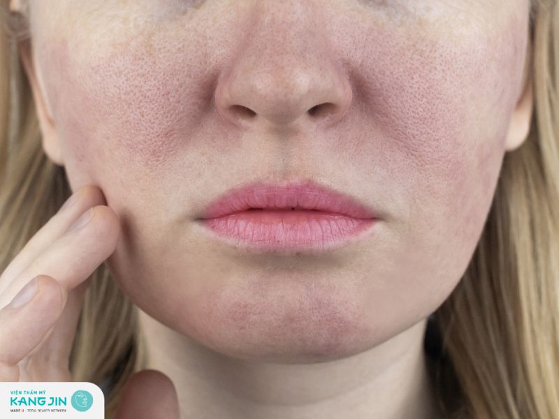 Tổng hợp các nguyên nhân khiến da sạm đen lỗ chân lông to