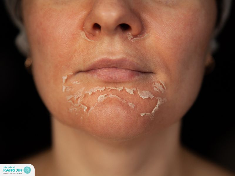 Sau peel da có thể bị bong tróc và ngứa rát 