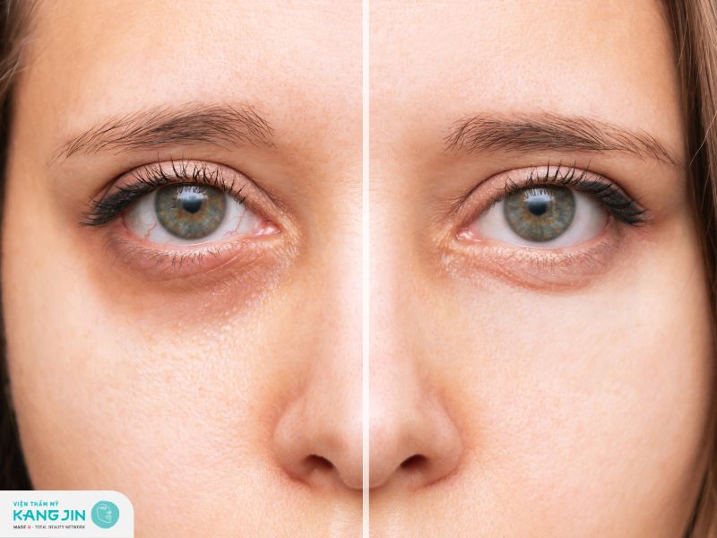 trị thâm mắt bằng vitamin e