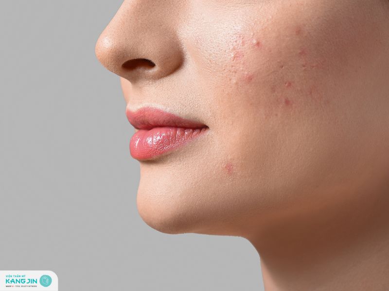 bị mụn ẩn có nên nặn không