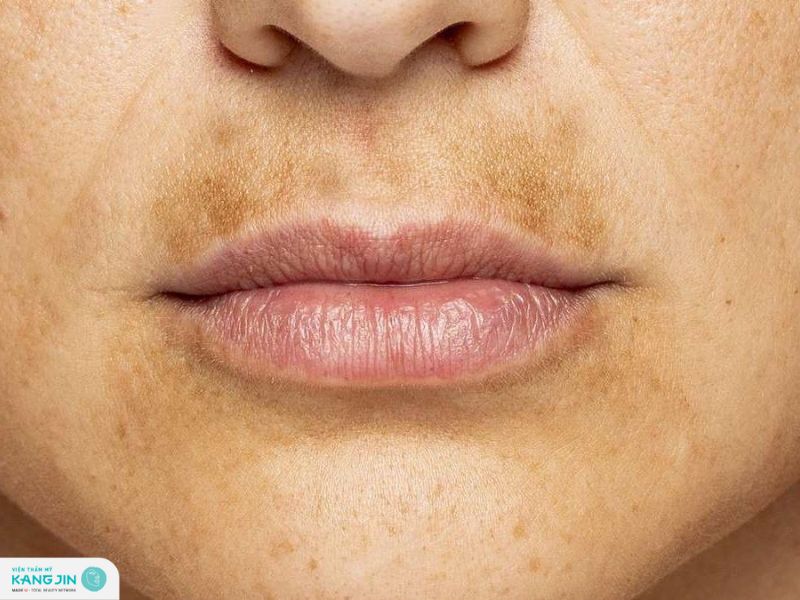 cách trị nám vùng miệng