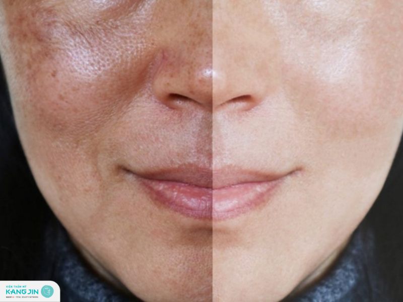 cách trị nám vùng miệng