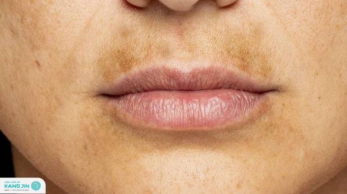 cách trị nám vùng miệng