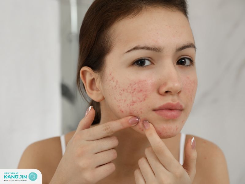 chăm sóc da mặt bị mụn và thâm