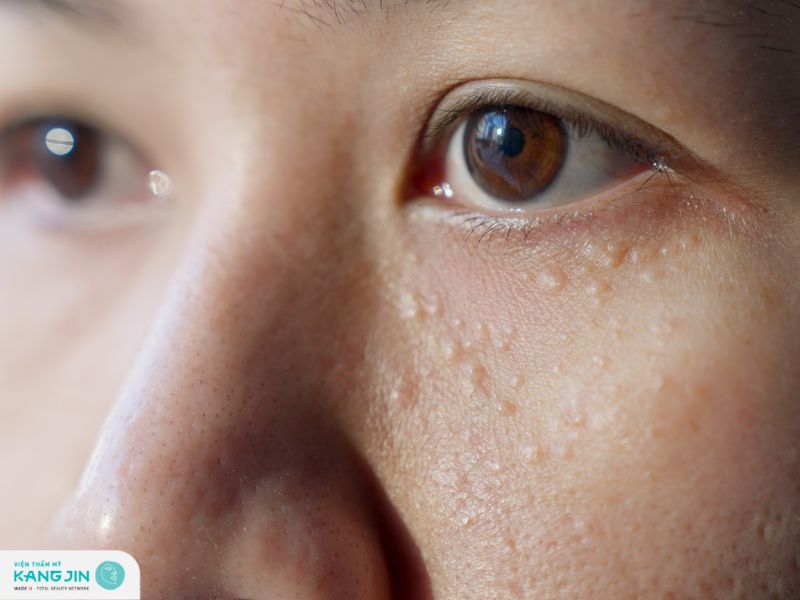 Tổng hợp các cách trị mụn ẩn quanh mắt
