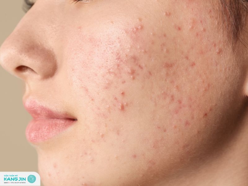 mụn sưng cứng dưới da