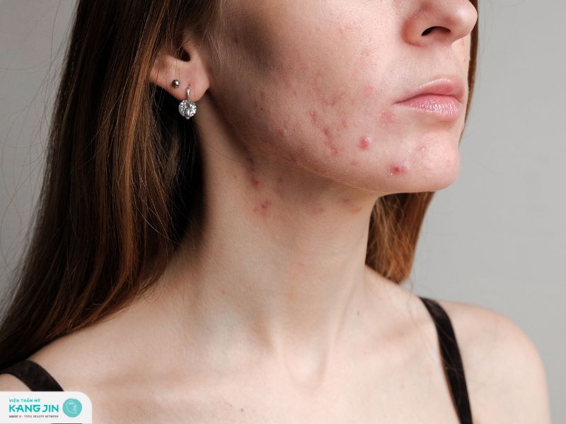 mụn sưng cứng dưới da