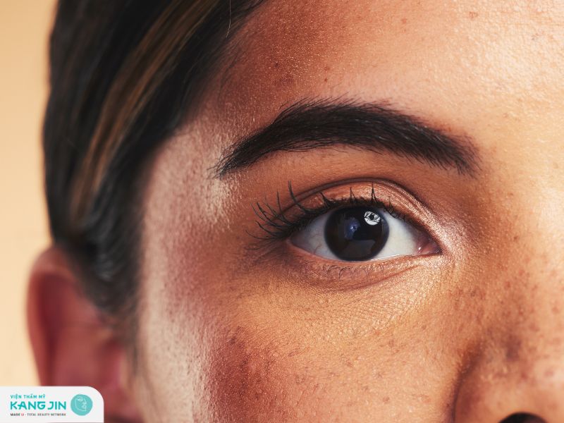 phân biệt nám và tàn nhang