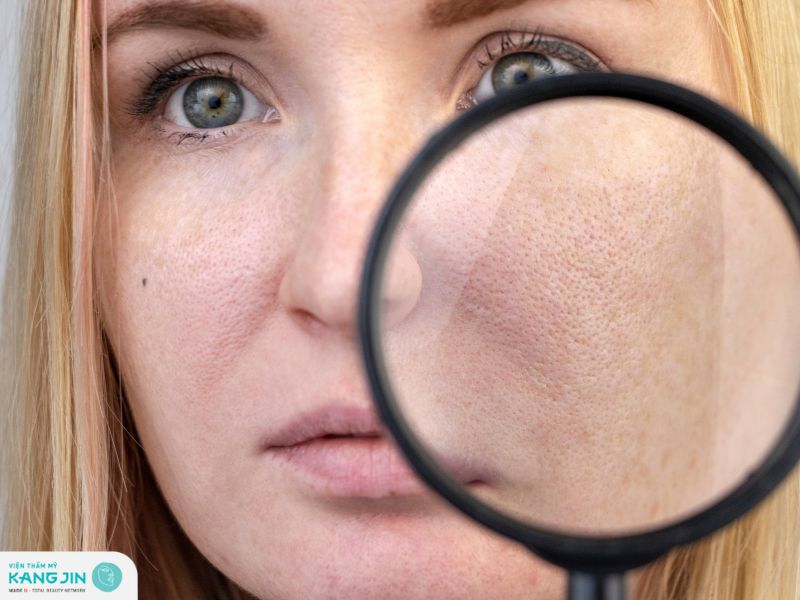 Da bị sạm đen lỗ chân lông to có gây ảnh hưởng gì không?