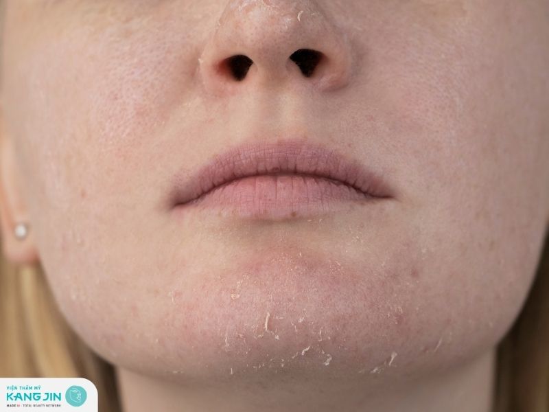 Trị nám bằng lá trầu không sai cách có thể gây bào mòn da