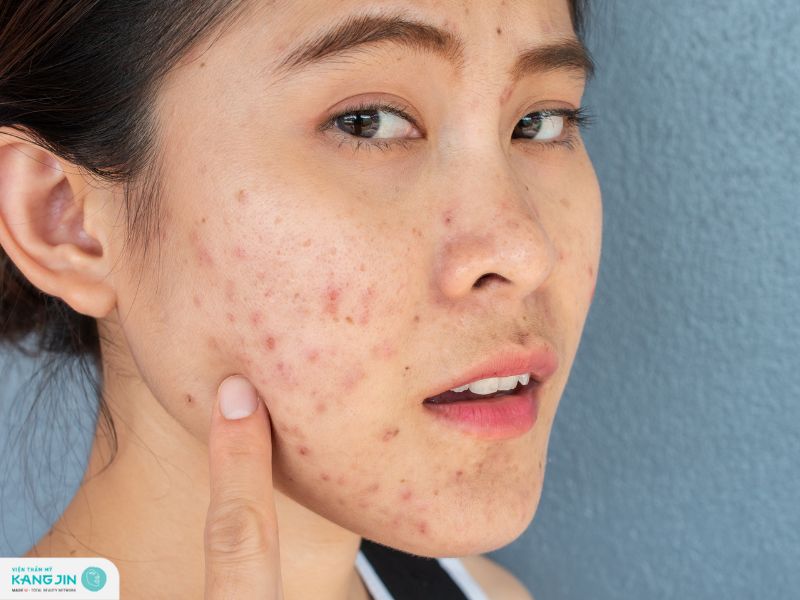 vết thâm mụn có tự hết không